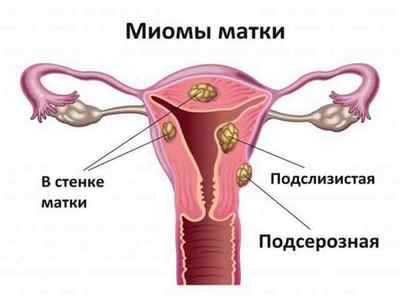 Причини, лікування, профілактика миоматоз матки