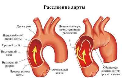 Причини і лікування розшарування аневризми аорти