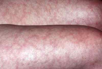 Причини мармурової шкіри на тілі у дорослих