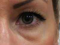 Причини мішків під очима: чому зявляються, лікування темних набряків