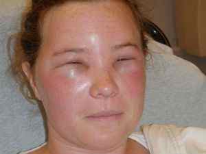 Причини набряку обличчя і очей: симптомом якого захворювання є, чому виникає набряклість
