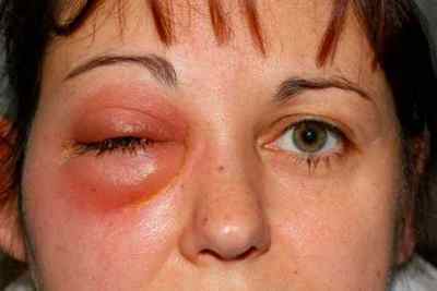 Причини набряку обличчя і очей: симптомом якого захворювання є, чому виникає набряклість