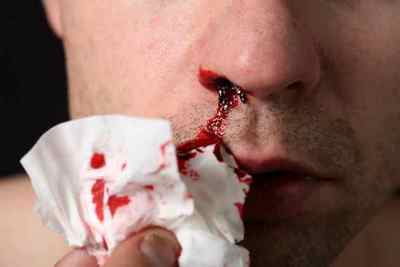 Причини носової кровотечі, як надати першу допомогу, які методи лікування існують