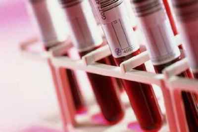 Причини підвищених лейкоцитів в крові після пологів