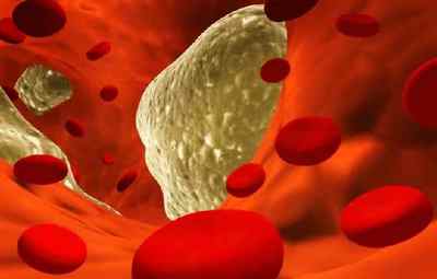 Причини підвищеного холестерину в крові у жінок