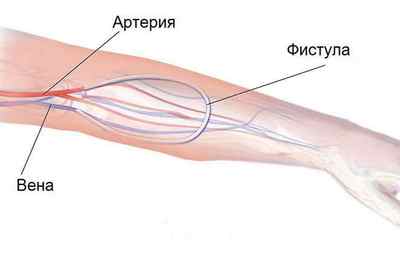 Причини появи артеріовенозної фістули і методи її лікування