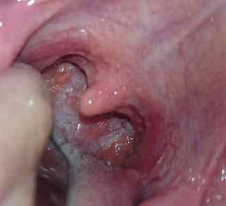 Причини появи, фото, симптоми і лікування папілом в горлі