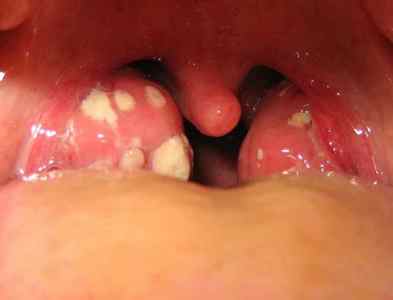 Причини появи, фото, симптоми і лікування папілом в горлі