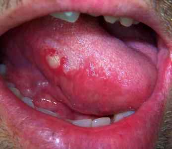 Причини появи і лікування кондилом в роті, на мові