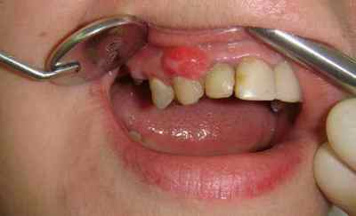 Причини появи і лікування кондилом в роті, на мові