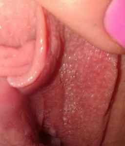 Причини появи, лікування та фото кондилом на статевих губах у жінок