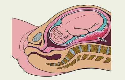 Причини появи ретроплацентарной гематоми при вагітності і методи її лікування