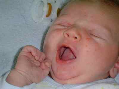 Причини пітниці на обличчі у немовляти - лікування