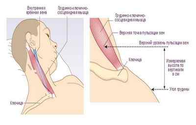 Причини розширення яремної вени на шиї і що при це робити