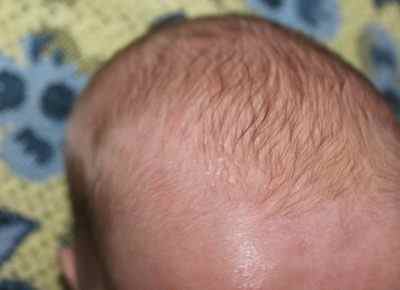 Причини розвитку, симптоми, лікування і фото псоріазу у дітей на голові