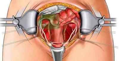 Причини, симптоматична картина і способи лікування ендометріозу шийки матки