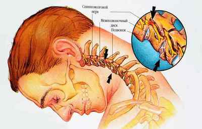 Причини спазму хребетної артерії і способи його лікування