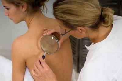 Причини та ефективне лікування бородавок на спині