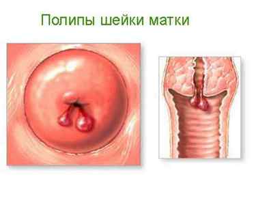Причини утворення і способи лікування поліпів шийки матки
