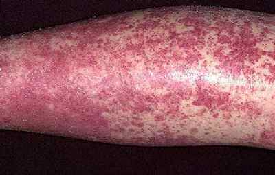 Причини виникнення алергічного васкуліту та методи його лікування