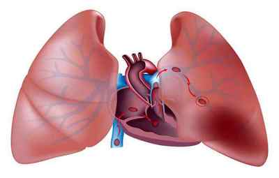 Причини виникнення аневризми легеневої артерії і способи її лікування
