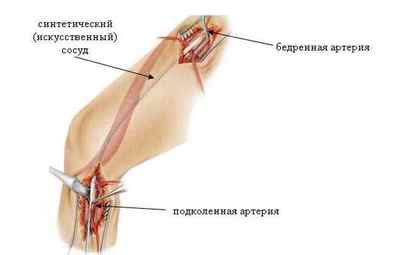 Причини виникнення аневризми стегнової артерії і методи її лікування