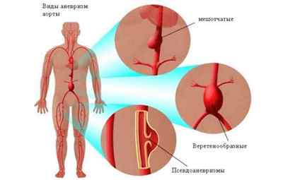 Причини виникнення аневризми стегнової артерії і методи її лікування