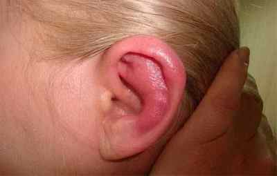 Причини виникнення гіперемії слухового проходу і методи її лікування