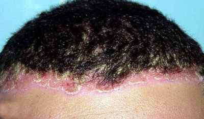 Причини виникнення псоріаз на голові і способи його лікування на волосистій частині
