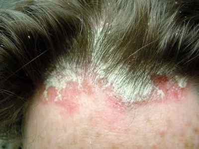 Причини виникнення псоріаз на голові і способи його лікування на волосистій частині