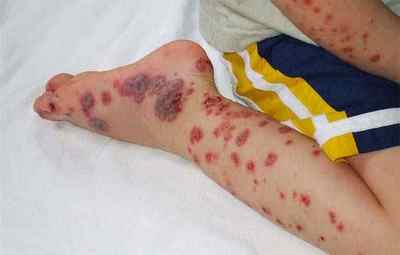Причини виникнення тромбоцитопенічного пурпура у дітей і його лікування