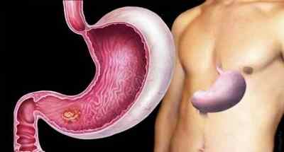 Причини виразки шлунка: фактори, що впливають на розвиток хвороби, її ускладнення