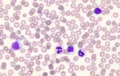 Причини знижених моноцитів в крові дорослого