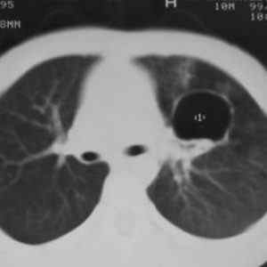 Прикореневій пневмосклероз легенів: що це таке і як його лікувати