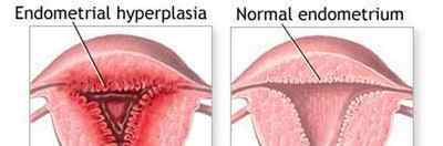 Призначення Норколуту при діагнозі гіперплазія ендометрію: відгуки пацієнток