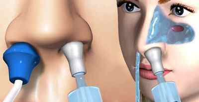 Процедура "зозуля" для промивання носа: що це таке і як її роблять