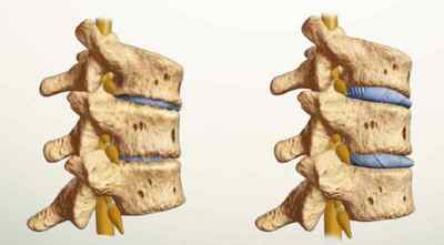 Пролапс міжхребцевого диска: симптоми і лікування, дорзальное пролабирование, що таке випадання диска в поперековому відділі | Ревматолог