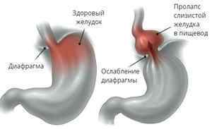 Пролапс слизової шлунка в стравохід: ознаки, діагностика, методи лікування