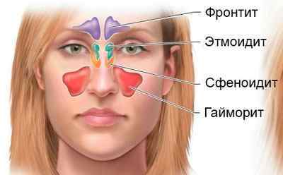 Промивання носа хлоргексидину при нежиті і гаймориті