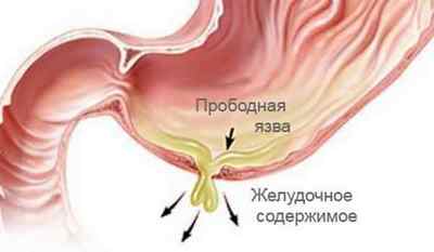 Проривна виразка шлунка: лікування за допомогою хірургії, харчування після операції