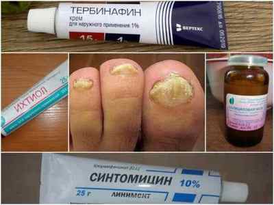 Протигрибкові мазі для шкіри і нігтів на ногах - огляд ефективних препаратів