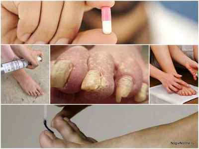 Протигрибкові препарати для ніг і нігтів - огляд кращих засобів, відгуки