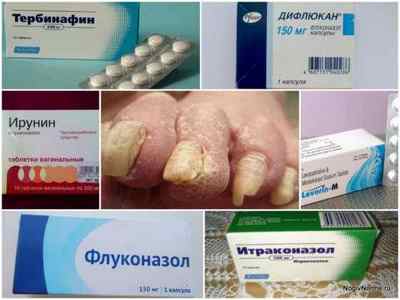 Протигрибкові таблетки для нігтів - огляд кращих препаратів