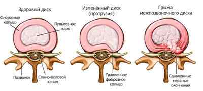 Протрузії дисків хребта поперекового відділу: як лікувати, що це таке, симптоми, вправи та ЛФК, гімнастика | Ревматолог