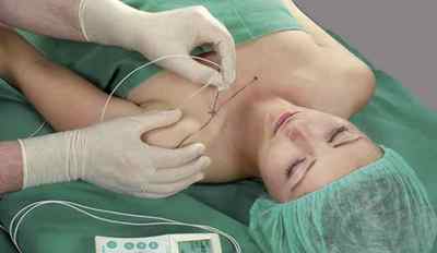 Провідникова анестезія: види, застосування, проведення