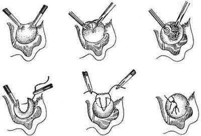 Проведення цистектомії яєчника: підготовка, етапи видалення кісти