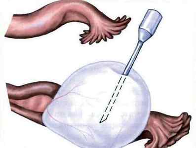 Проведення цистектомії яєчника: підготовка, етапи видалення кісти