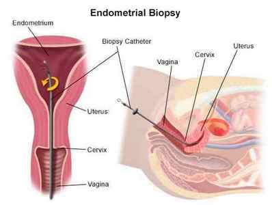 Проведення Пайпель біопсії ендометрія: показання до процедури, відгуки