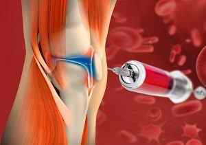 PRP-терапія для лікування суглобів: відгуки, плазмоліфтінг колінного суглоба і лікування суглобів плазмою крові збагаченої тромбоцитами | Ревматолог