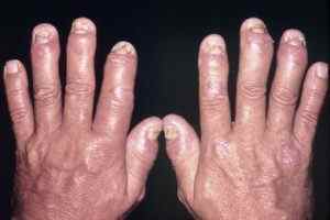 Псоріатичний артрит: симптоми і лікування, фото і діагностика, дають інвалідність чи ні | Ревматолог